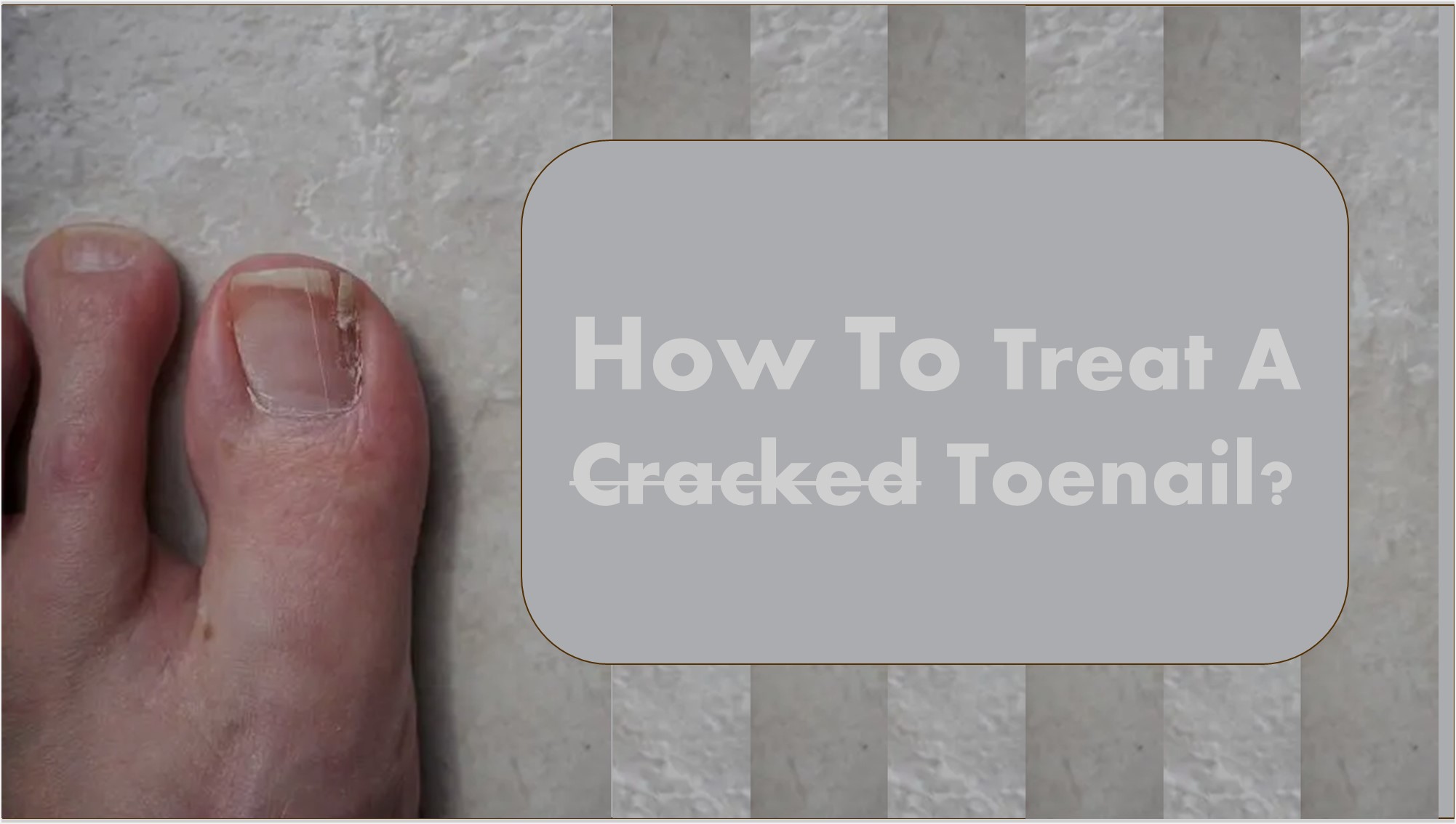 cracked-toenail-why-is-my-toenail-cracked-boot-walker